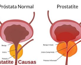 Prostatite: a doença inflamatória da próstata